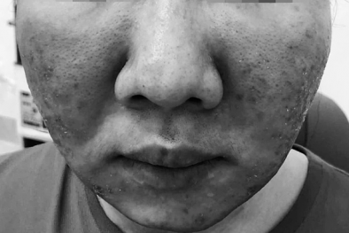 Nữ sinh cháy da vì bôi kem 'siêu chống nắng SPF 70 nội địa Nhật' giá rẻ trên mạng